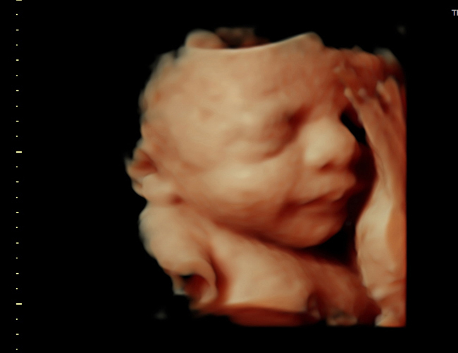 3D ultrasound image at 31 weeks
